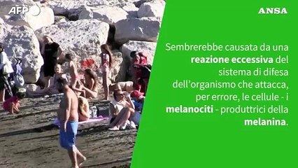 Ansa VERIFIED - Con la vitiligine si puo' prendere il sole?