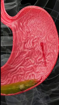 Hemorrhagic Gastric Ulcers Explained Causes of Bleeding Stomach Ulcers Gastric Ulcer Animation गैस्ट्रिक अल्सर टीकाकरण تحصين قرحة المعدة Bleeding Stomach Ulcer Animation