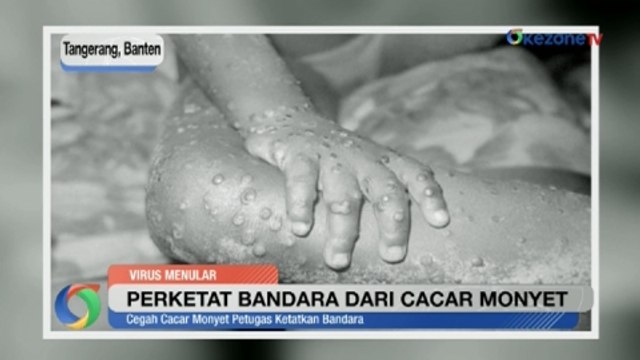 Perketat Bandara dari Cacar Monyet