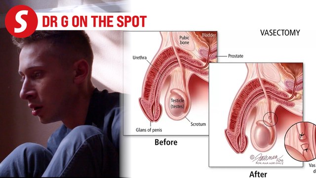EP237: No pain but all gains in getting a vasectomy | PUTTING DR G ON THE SPOT