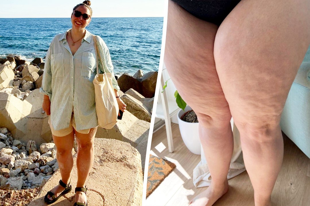 I was bullied and called 'thunder thighs' due t...