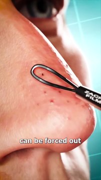 How Blackhead Extraction Works #Viral #Viralvideo #USA #Canada #Trending #TrendingVideo #Famous #FamousVideo