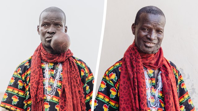 Teacher who quit due to MELON-SIZED face tumour unrecognisable after surgery