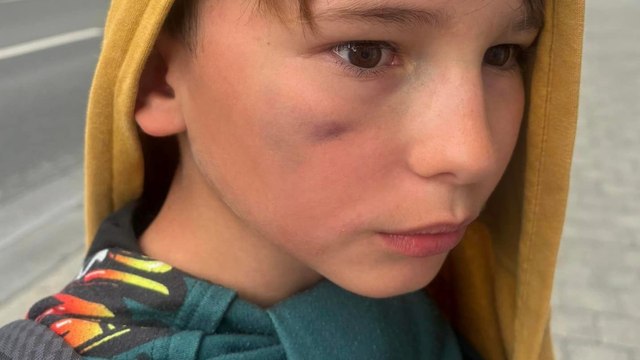 « Ils le réveillaient avec des claques » : la mère de Jean, couvert de bleus en colonie de vacances, raconte son « calvaire »