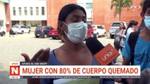 mujer con 80% de cuerpo quemado