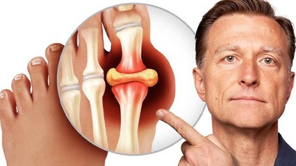 High Uric Acid से Kidney Stone Risk कैसे | Uric Acid Stones Symptoms & Treatment | Boldsky