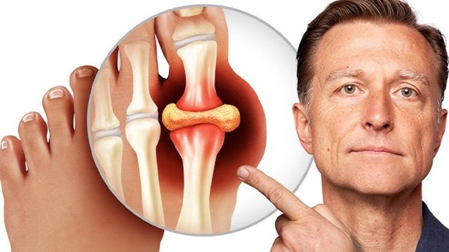 High Uric Acid से Kidney Stone Risk कैसे | Uric Acid Stones Symptoms & Treatment | Boldsky