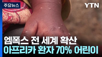 콩고서 일주일 새 엠폭스 환자 천여 명..."확진자 70% 어린이" / YTN