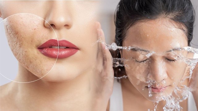 Face Open Pores Treatment: ओपन पोर्स कैसे ठीक करें | Remove & Home Remedy In Hindi|Boldsky