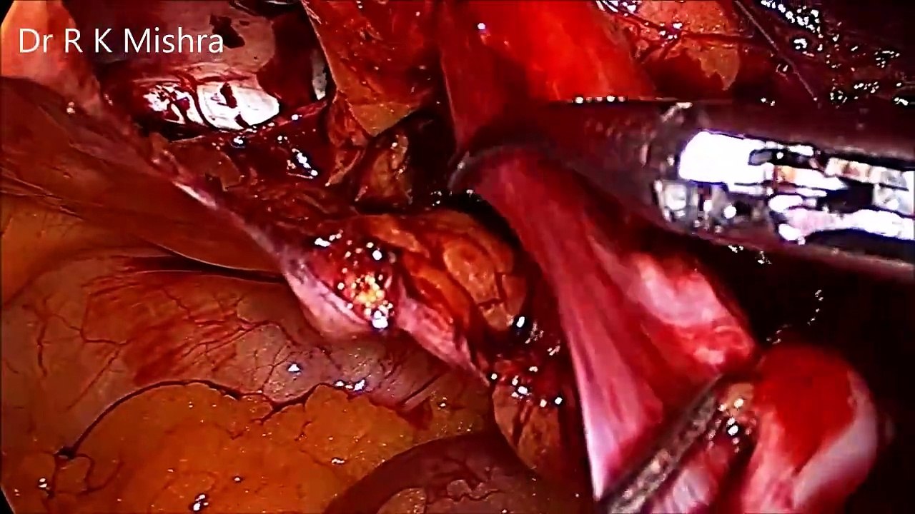 Laparoscopic Hernia Surgery TAPP