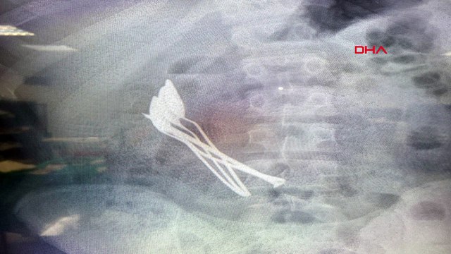 Kayseri'de akıllara durgunluk veren olay: 15 yaşındaki çocuğun midesinden çıkanlar şoke etti