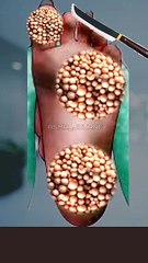 Feet Infection removal animation #removal #asmrtriggers #satisfying