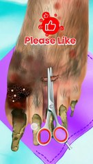 ASMR foot care remove big plantar worm & psoriasis 2d  animation treatment video