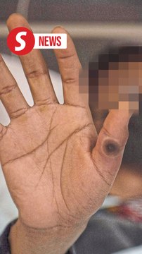 One new mpox case detected, says Health Ministry