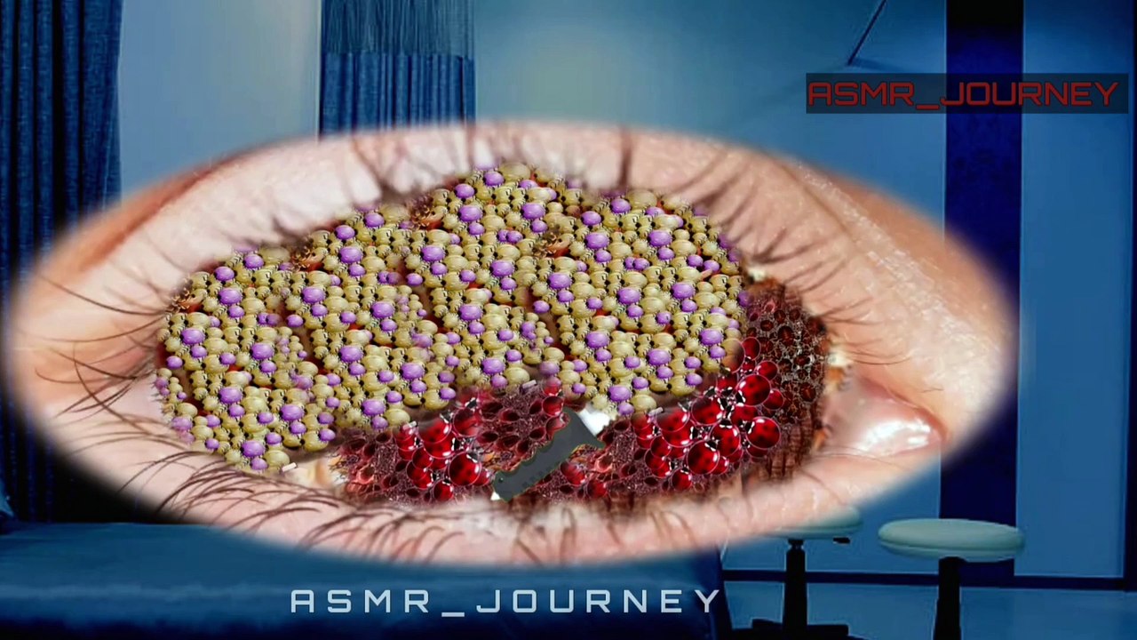 ASMR Eye Cleaning: Maggot & Dog Tick Removal Animation | Ultimate Treatment & Care"