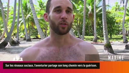 Download Video: Près de deux mois après la perte de ses doigts, Maxime (Koh-Lanta) partage des photos non censurées