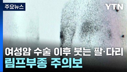 여성암 수술 이후 붓는 팔·다리...림프부종 주의보 / YTN