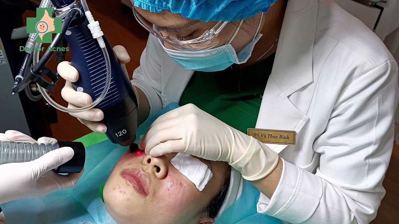 Có nên điều trị sẹo khi da đang bị mụn không? - Phòng khám Da liễu Doctor Acnes