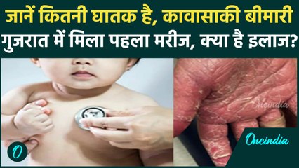 Kawasaki Disease In India: कावासाकी बीमारी की गुजरात में एंट्री, बच्चों को लेकर रहें सतर्क|