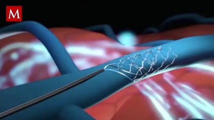 Hombre logra controlar su Alexa con la mente gracias a implante cerebral