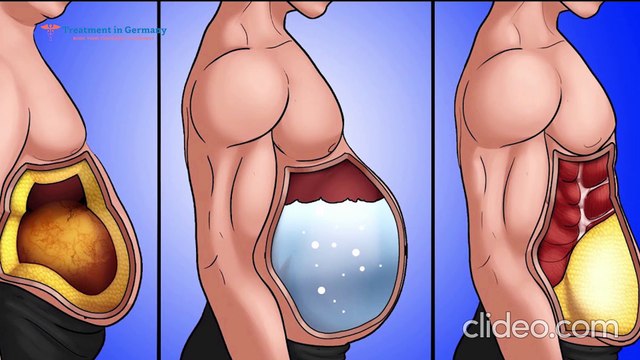 what is abdominal obesity