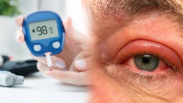 Sugar Me Ankhon Ke Upper Swelling Kyu Aati Hai | Does Diabetes Cause Swollen Eyelids Reason