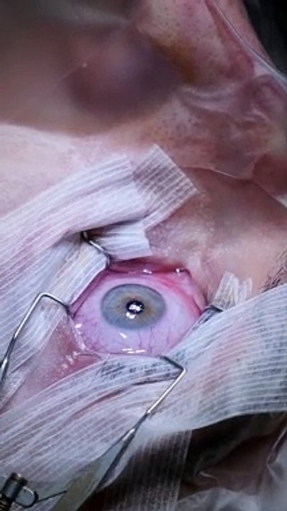 J'ai pu filmer mon opération des yeux - le fameux Lasik ! Et je trouvais les images plutôt cools(ou effreyantes)