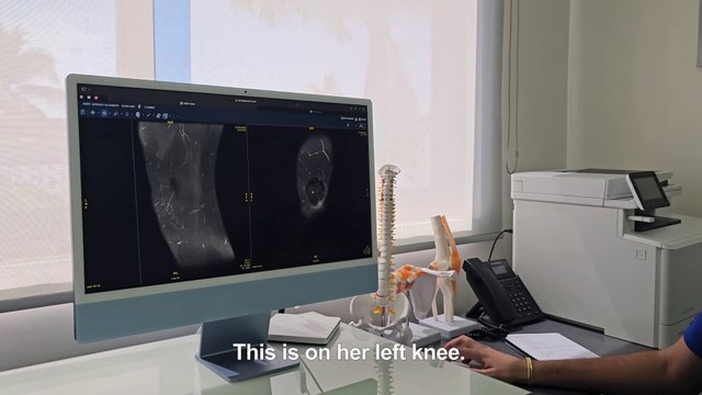 Shirleys Before and After Knee MRIs - Huge Improvement to Arthritis ACL and Meniscus from