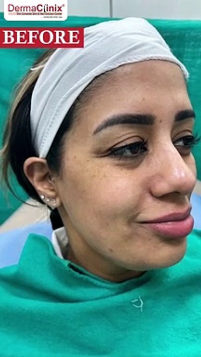 Lip and Cheeks Augmentation by Fillers | Fillers Treatment in Delhi | Patient Testimonial Netherland