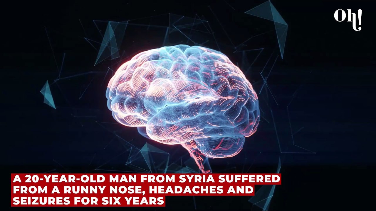 Man had a runny nose for six years before doctors discovered he had a hole in his skull