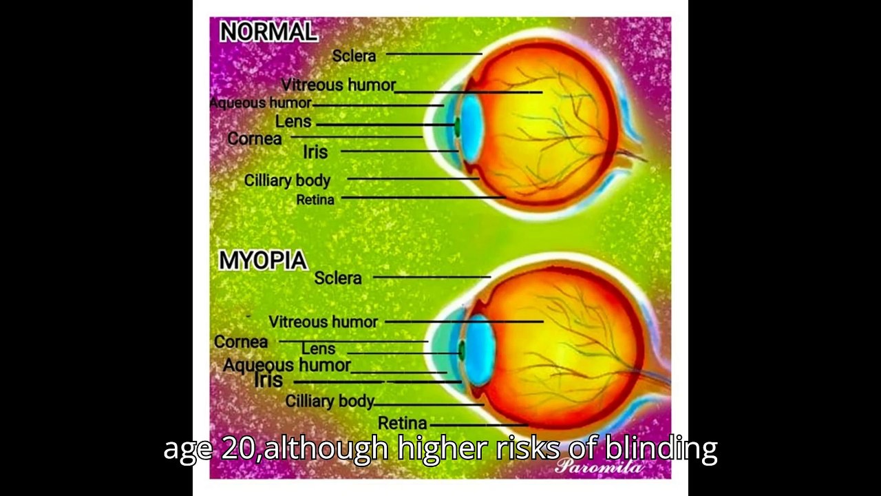 Myopia will affect 740m children and teenagers by 2050, research suggests |Screens are NOT the reason kids need glasses gest