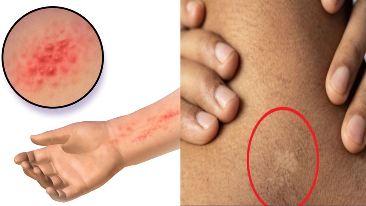 Blood Allergy Symptoms & Home Remedy: Khoon Me Allergy Ke Lakshan & Ilaj | Boldsky