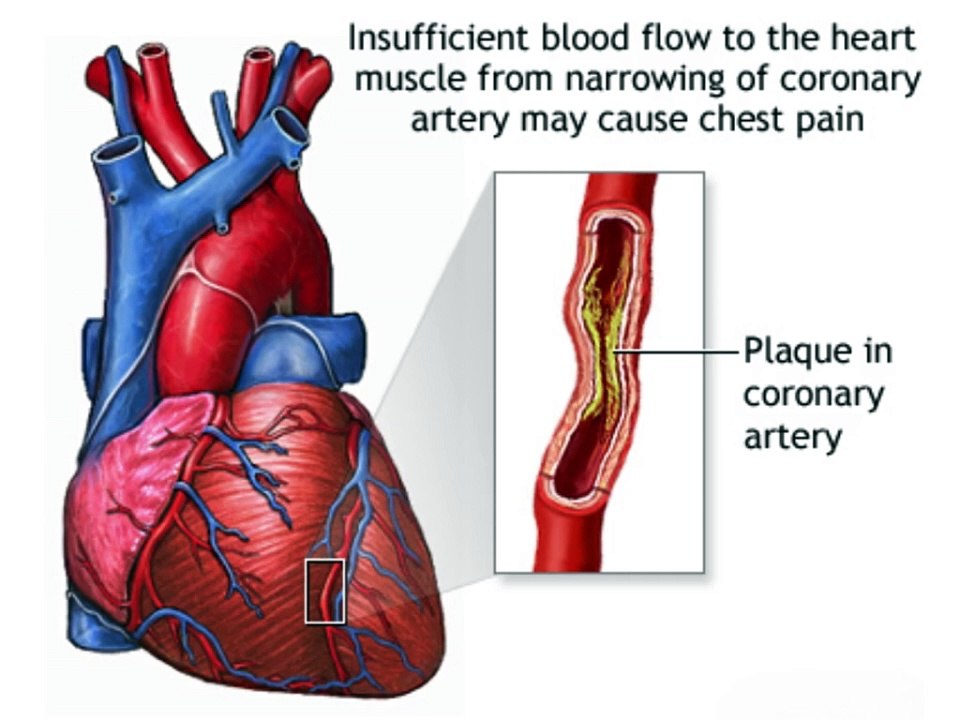 3 coronary artery diseases information in hindi which every one should know to prevent heart attack,