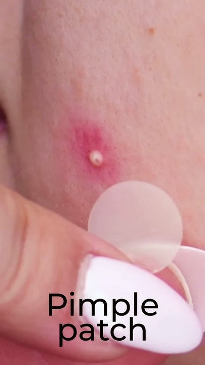 Are you using pimple patches or this hack to get rid of your pimple_ #shorts