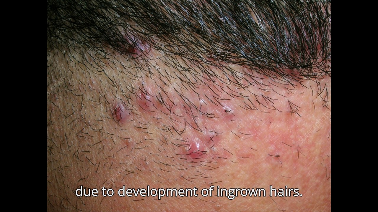 BIGGEST BUMP EVER! AKN Removal and Reaction| Acne Keloidalis Nuchae