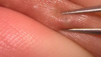 Ingrown hair gets skillfully removed with tweezers in this strangely soothing video