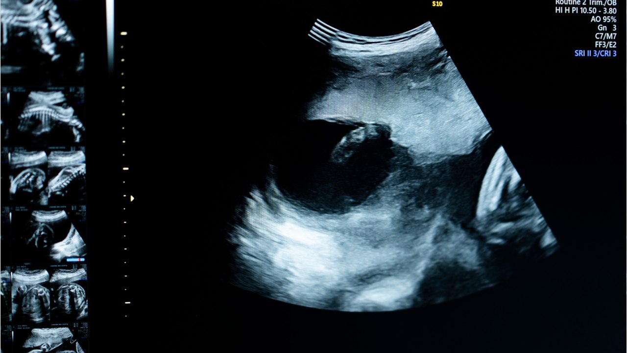 81-year-old Brazilian woman dies after carrying a 'stone baby' for over 50 years