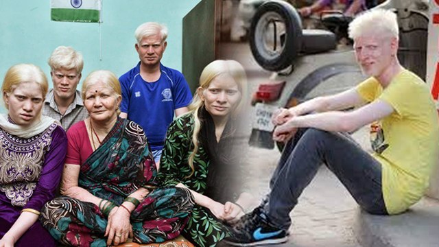 Is Sunflower Syndrome Curable, Causes, Symptoms & Treatment In Hindi | Boldsky