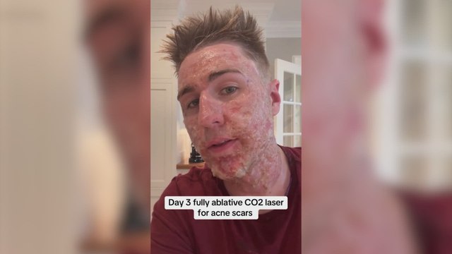 Adiós a las cicatrices del acné: un dermatólogo revela el tratamiento revolucionario