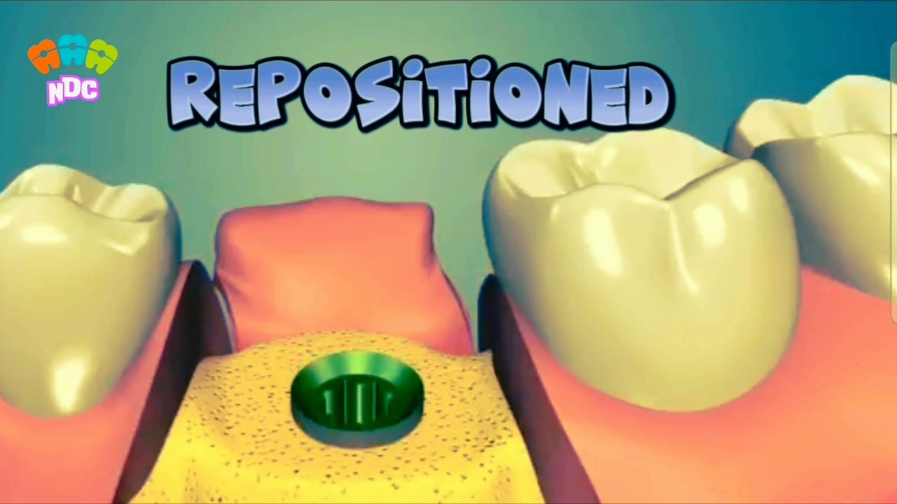 Dental implant procedure