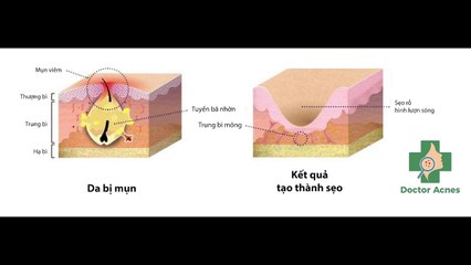 Tuổi tác ảnh hưởng đến kết quả trị sẹo rỗ như thế nào?