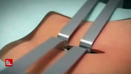 Bel fıtığı çıkarılma ameliyatı