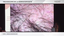 Trichoscopie de la dermatomyosite par Dr L. BENCHEKROUN