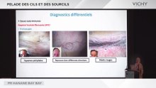Pelade des cils et sourcils par Pr H. BAY BAY