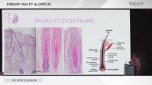 Erbium YAG et Alopécie par Dr R. CHRAIBI