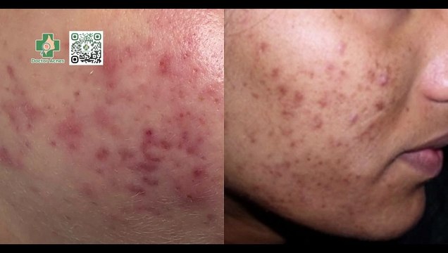 Thâm mụn bao lâu thì hết? Cách trị thâm mụn hiệu quả