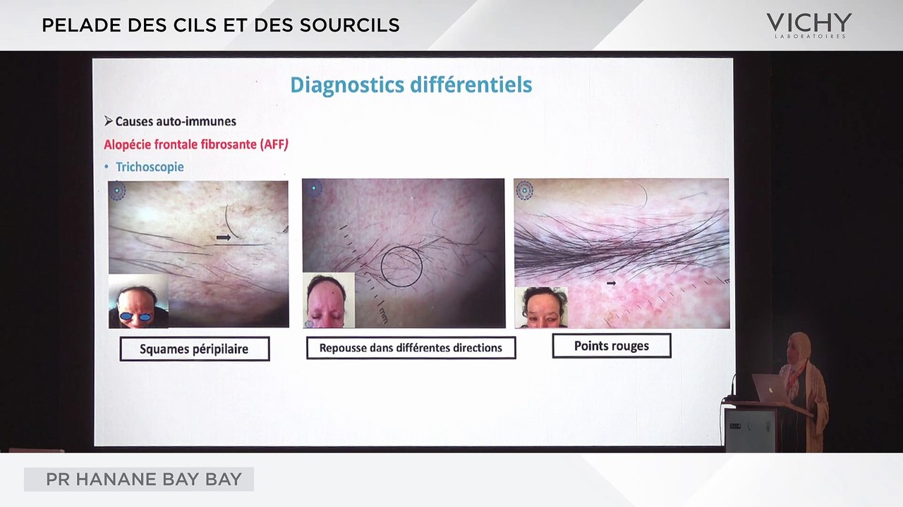 Pelade des cils et des sourcils par Pr H. BAY BAY