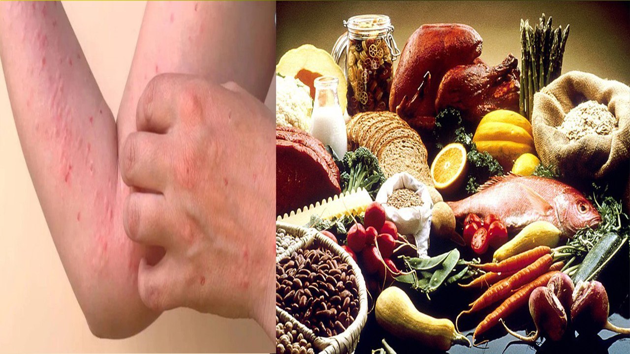 Chikungunya Me Kya Khana Chahiye Kya Nahi Khana Chahiye, Diet Plan...