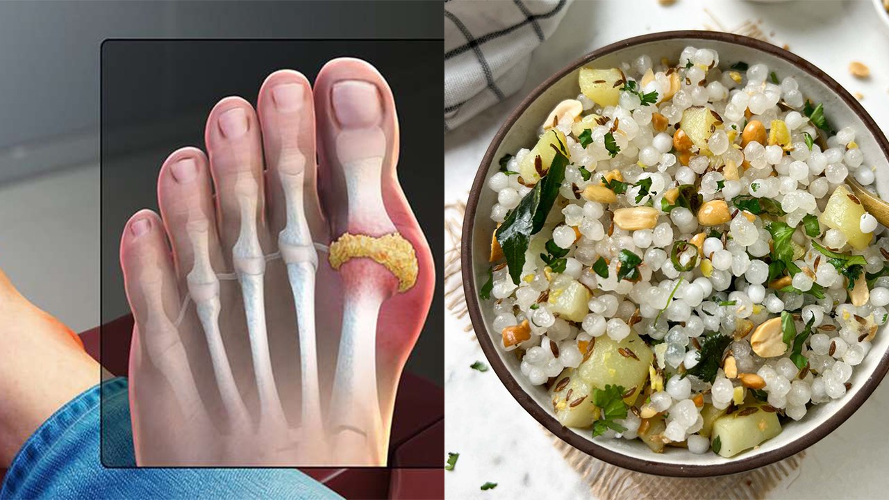 Is Sabudana Good For Uric Acid: High Uric Acid Me Sabudana Khana Chahiye Ya Nahi | Boldsky