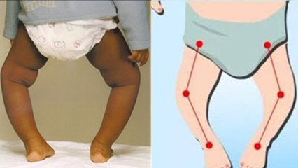 Newborn Baby Bowed Legs: बच्चों के पैर मुड़े हुए क्यों होते है, Symptoms & Treatment | Boldsky